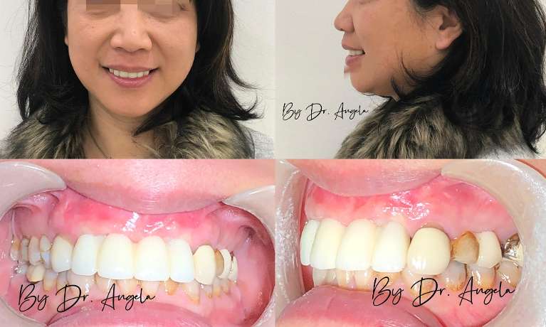 2-Anterior-Dental-Implants-following-by-Implant-Bridge-After-Image