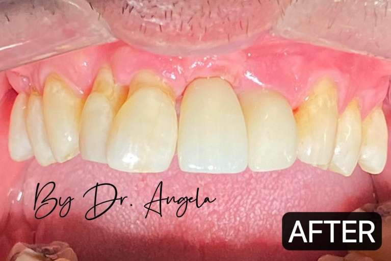 2-Front-Teeth-Dental-Implants-After-Image