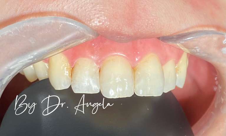 Composite-Veneer-on-Chipped-Front-Tooth-After-Image