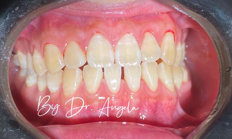 Dental-Hygiene-with-AIRFLOW-Dental-Spa-Treatment-After-Image