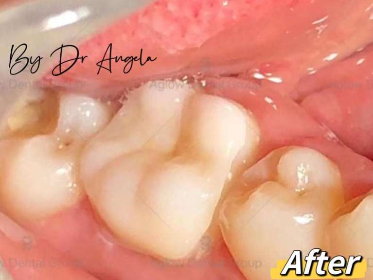 Dental-Onlay-After-Image