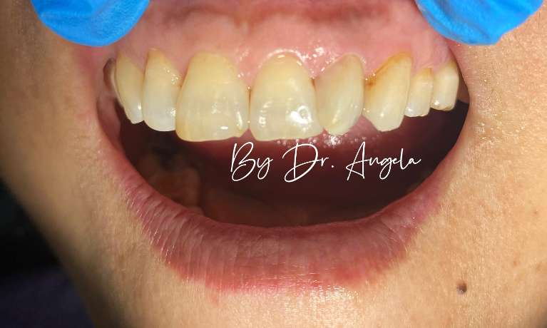 Tooth-Coloured-Fillings-on-Front-Tooth-After-Image