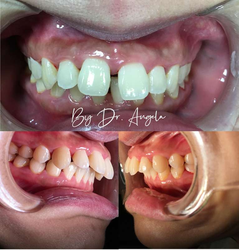 18-Months-Of-Invisalign-Treatment-Before-Image