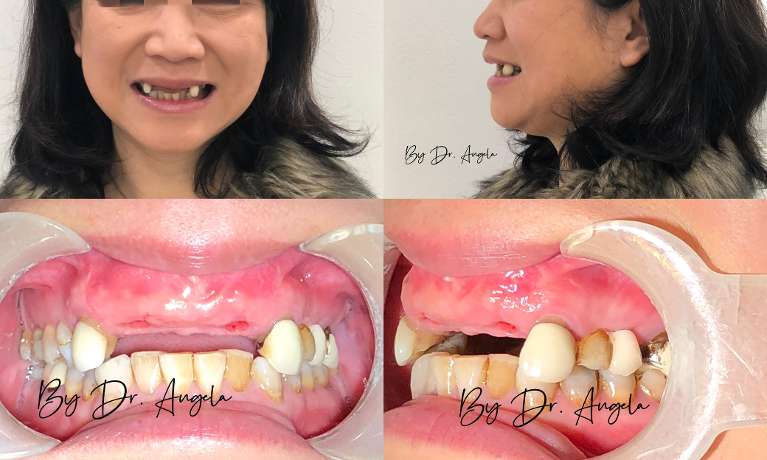 2-Anterior-Dental-Implants-following-by-Implant-Bridge-Before-Image