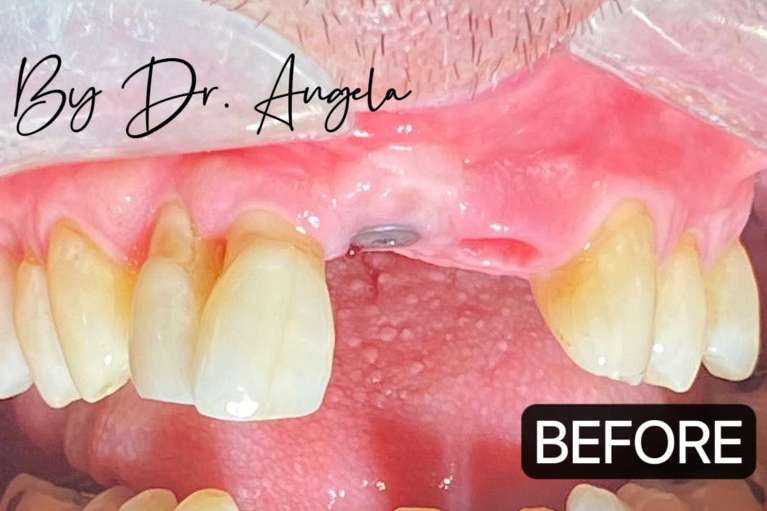 2-Front-Teeth-Dental-Implants-Before-Image