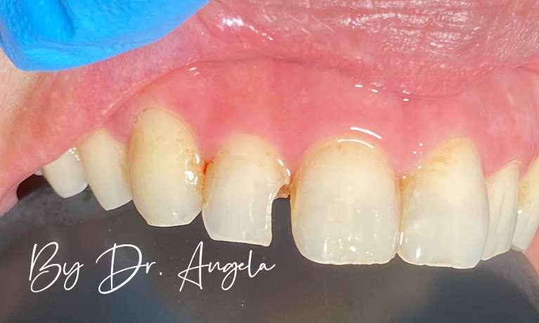 Composite-Veneer-on-Chipped-Front-Tooth-Before-Image