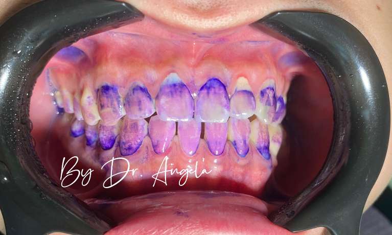 Dental-Hygiene-with-AIRFLOW-Dental-Spa-Treatment-Before-Image