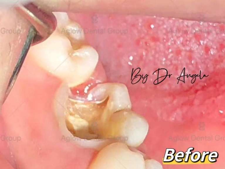 Dental-Onlay-Before-Image