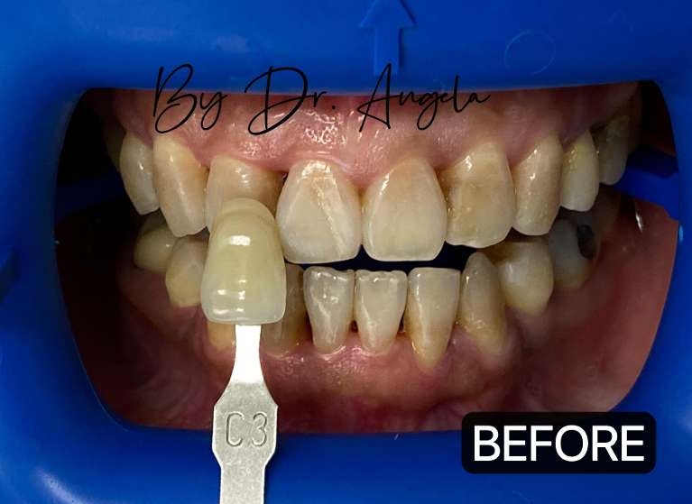 Teeth-Whitening-with-PHILIPS-ZOOM-Before-Image